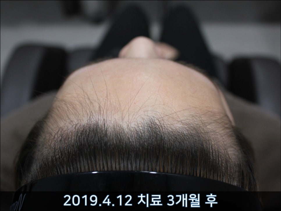 연세봄빛피부과 탈모치료 #37 (여성형탈모, 정수리탈모) 관련 이미지 5