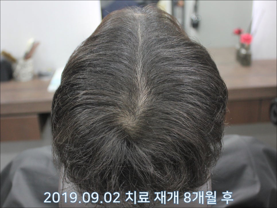 연세봄빛피부과 탈모치료 #25 (남성형탈모, 재치료, 이마탈모, 정수리탈모) 관련 이미지 4