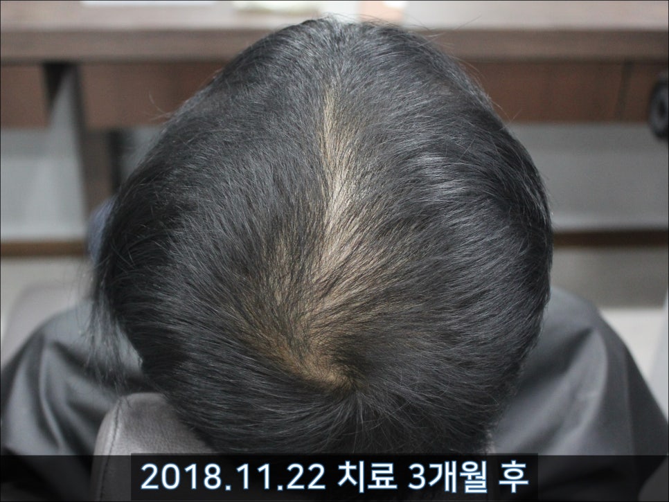 연세봄빛피부과 탈모치료 #39 (남성형탈모, 치료 중단 후 재치료) 관련 이미지 2