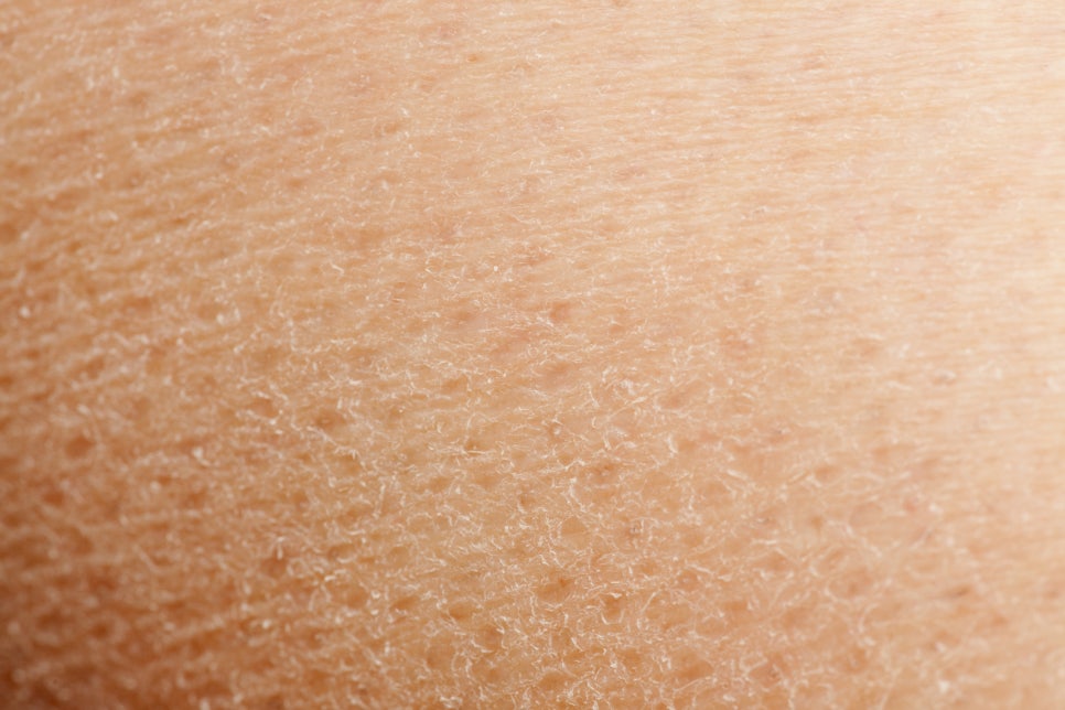 겨울철 생기는 피부건조증, 건성습진  #1 (증상, 원인, 가습기추천) 관련 이미지 2