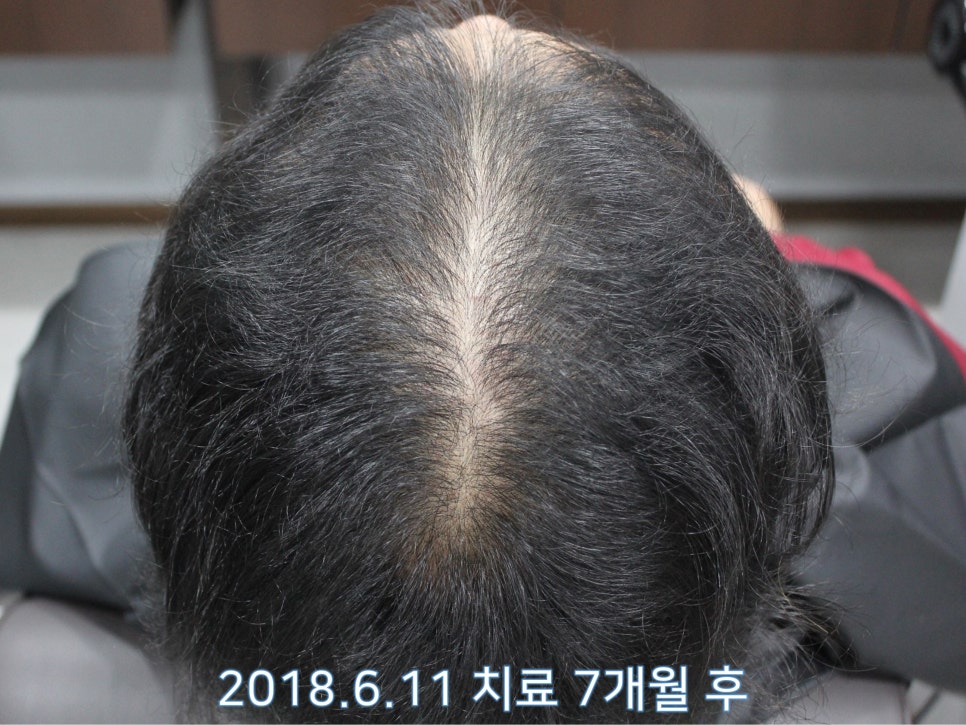 연세봄빛피부과 탈모치료 #11 (남성형탈모, 이마탈모, 정수리탈모) 관련 이미지 6