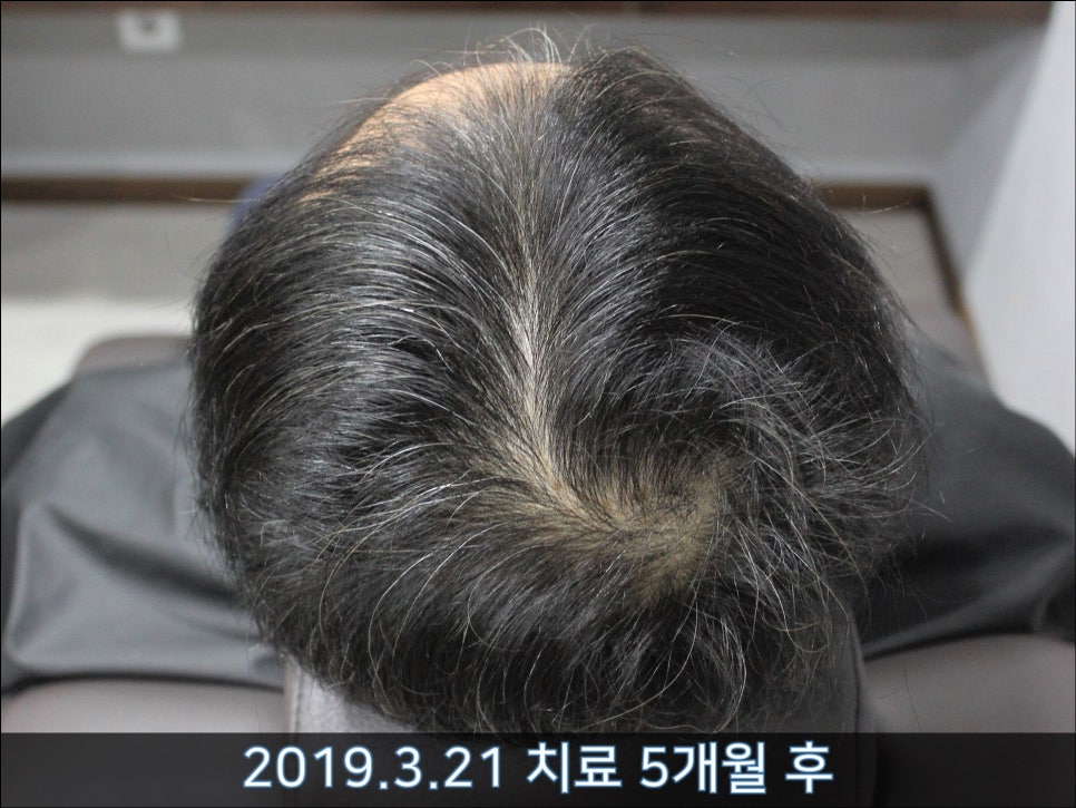 연세봄빛피부과 탈모치료 #30 (남성형탈모, 이마탈모, 정수리탈모) 관련 이미지 3