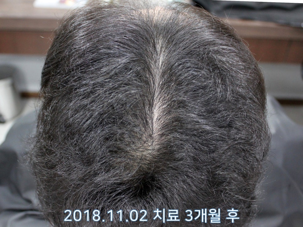 연세봄빛피부과 탈모치료 #15 (남성형탈모, 이마탈모, 정수리탈모) 관련 이미지 2