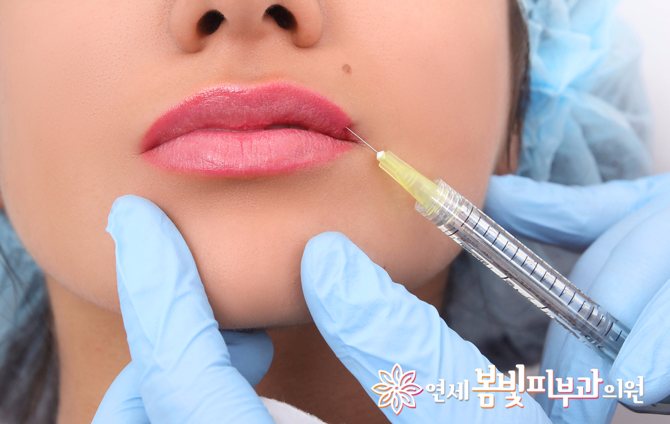 입술 필러로 티 안나게 예뻐지기~ 관련 이미지 3