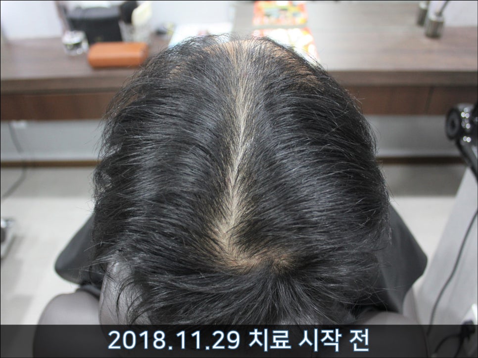 연세봄빛피부과 탈모치료 #35 (남성형탈모, 이마탈모, 가족력없음) 관련 이미지 5