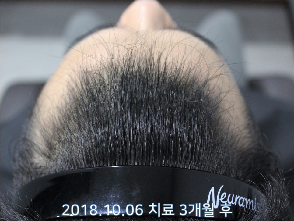 연세봄빛피부과 탈모치료 #27 (남성형탈모, 이마탈모 정수리탈모) 관련 이미지 5