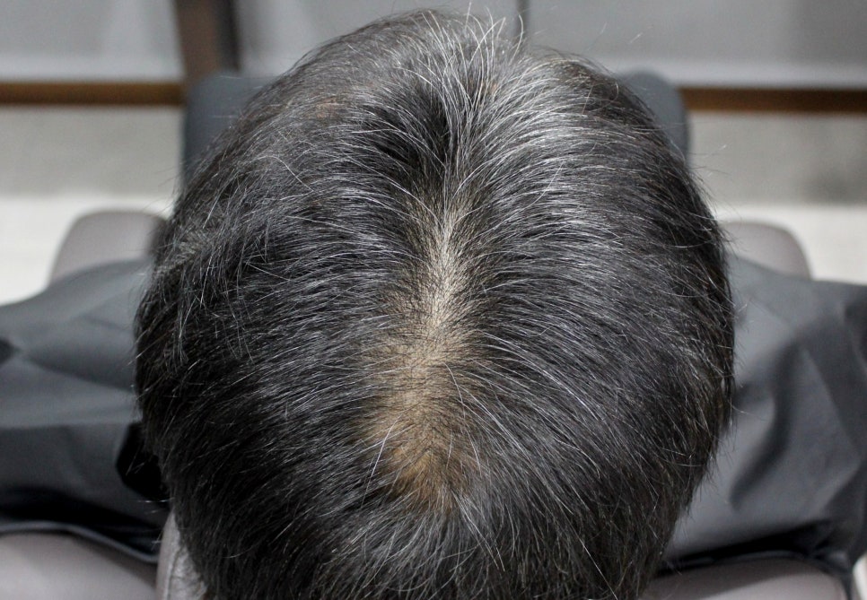 연세봄빛피부과 탈모치료 #5 (남성형탈모, 이마탈모, 정수리탈모) 관련 이미지 5