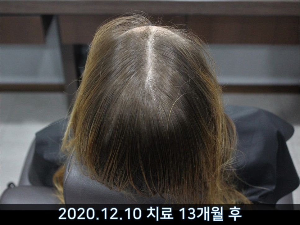 연세봄빛피부과 탈모치료 #40 (여성형탈모, 외국인의 경우) 관련 이미지 3