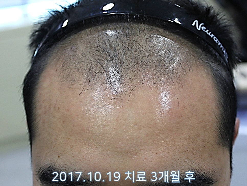 연세봄빛피부과 탈모치료 #9 (남성형탈모, 이마탈모, 정수리탈모) 관련 이미지 2