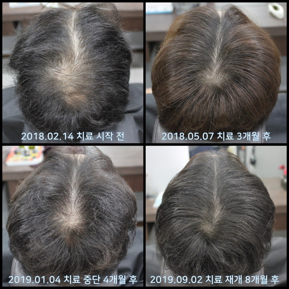 연세봄빛피부과 탈모치료 #25 (남성형탈모, 재치료, 이마탈모, 정수리탈모) 관련 이미지 5