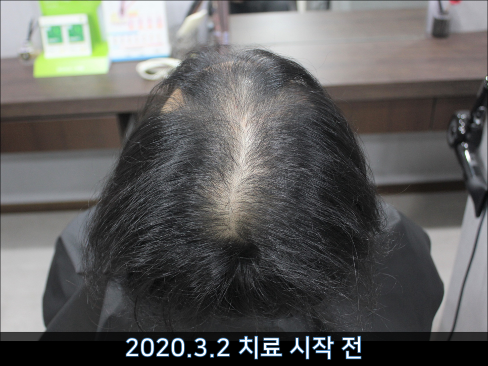 연세봄빛피부과 탈모치료 #44 (남성형탈모,M형+C형탈모) 관련 이미지 2