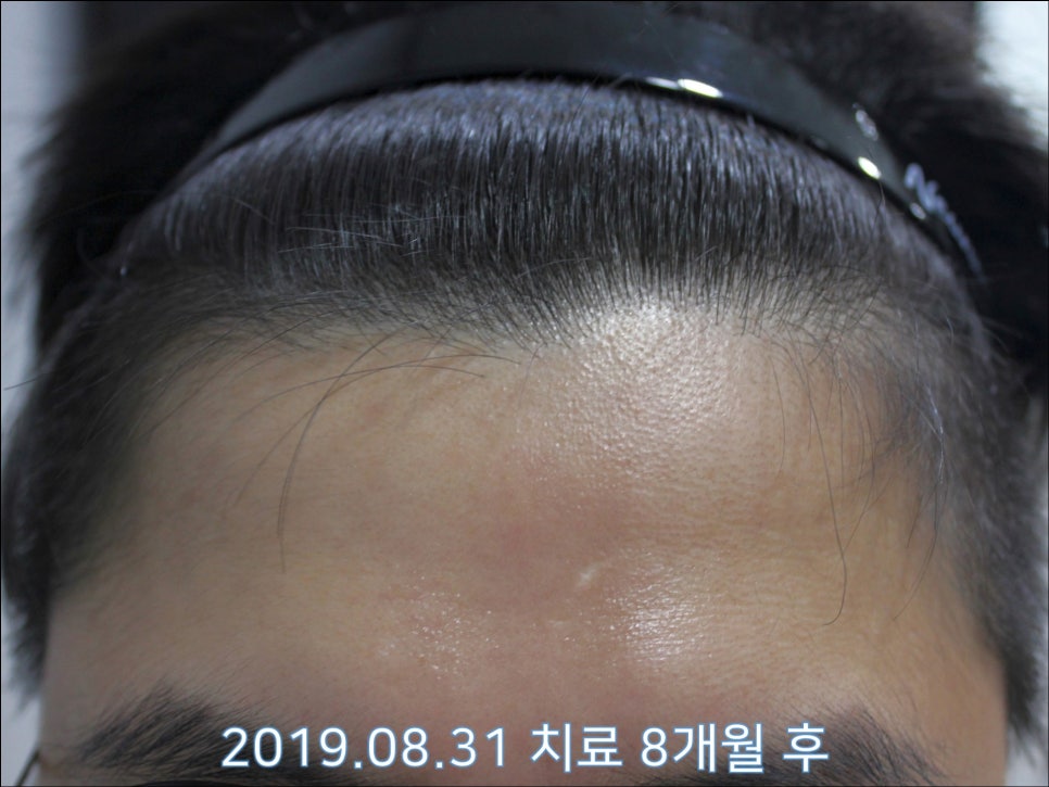 연세봄빛피부과 탈모치료 #28 (남성형탈모, 정수리탈모) 관련 이미지 5