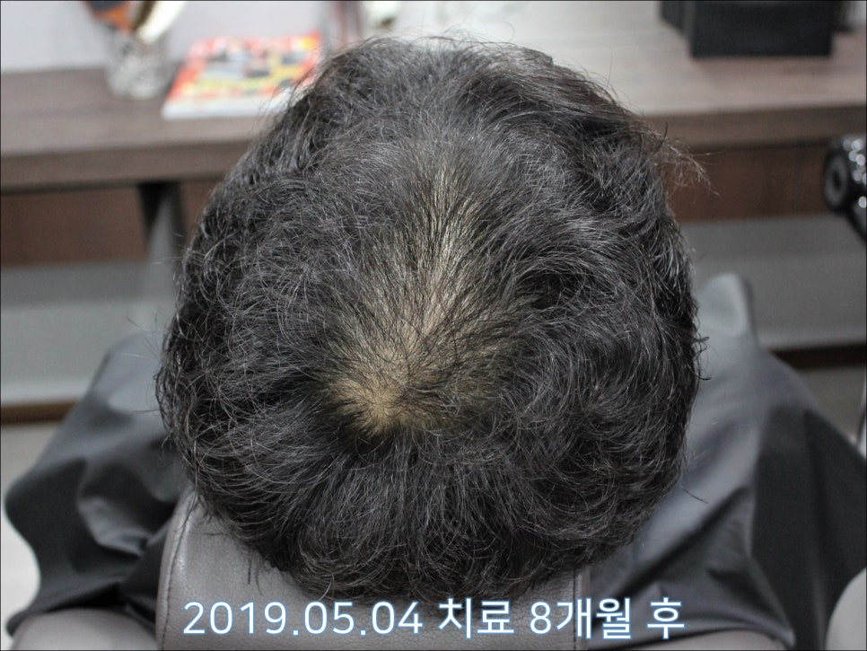 연세봄빛피부과 탈모치료 #29 (남성형탈모, 정수리탈모, 15개월간 장기 치료) 관련 이미지 3