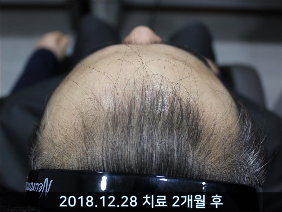 연세봄빛피부과 탈모치료 #30 (남성형탈모, 이마탈모, 정수리탈모) 관련 이미지 6