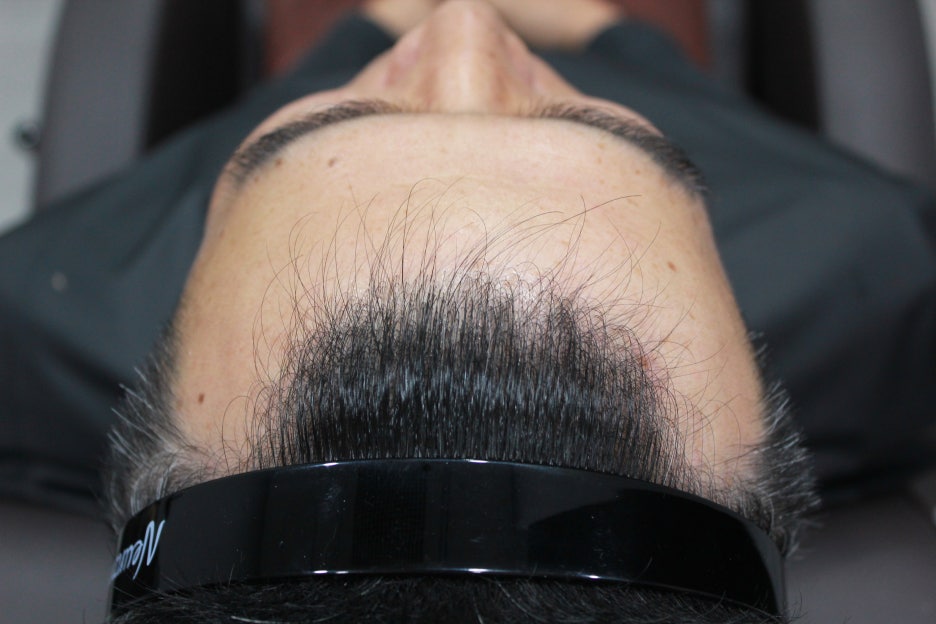 연세봄빛피부과 탈모치료 #4-1 (남성형탈모, 이마탈모, 정수리탈모, 6개월치료 경과 업데이트) 관련 이미지 1