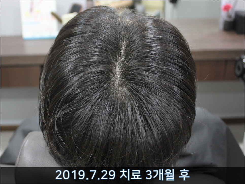 연세봄빛피부과 탈모치료 #34 (남성형탈모, 모발이식 후 치료) 관련 이미지 4