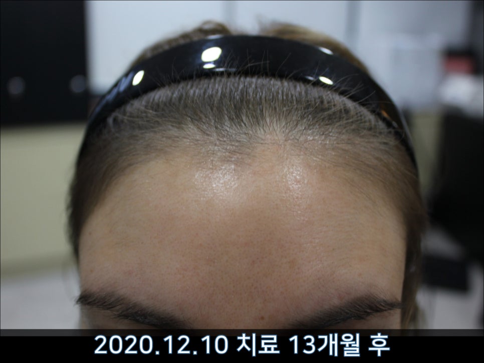 연세봄빛피부과 탈모치료 #40 (여성형탈모, 외국인의 경우) 관련 이미지 7