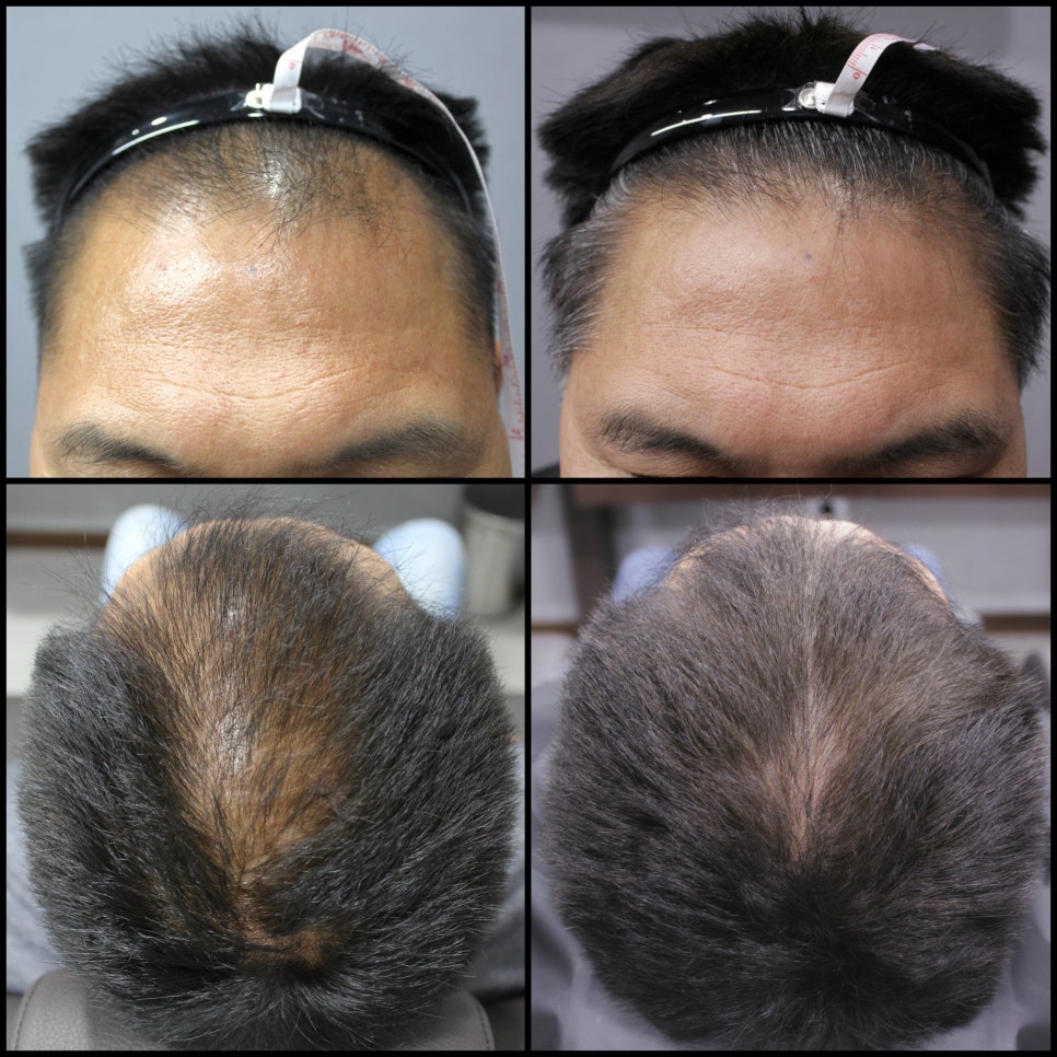 연세봄빛피부과 탈모치료 #3 (남성형탈모, 이마탈모, 정수리탈모) 관련 이미지 1