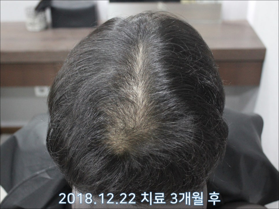 연세봄빛피부과 탈모치료 #29 (남성형탈모, 정수리탈모, 15개월간 장기 치료) 관련 이미지 2