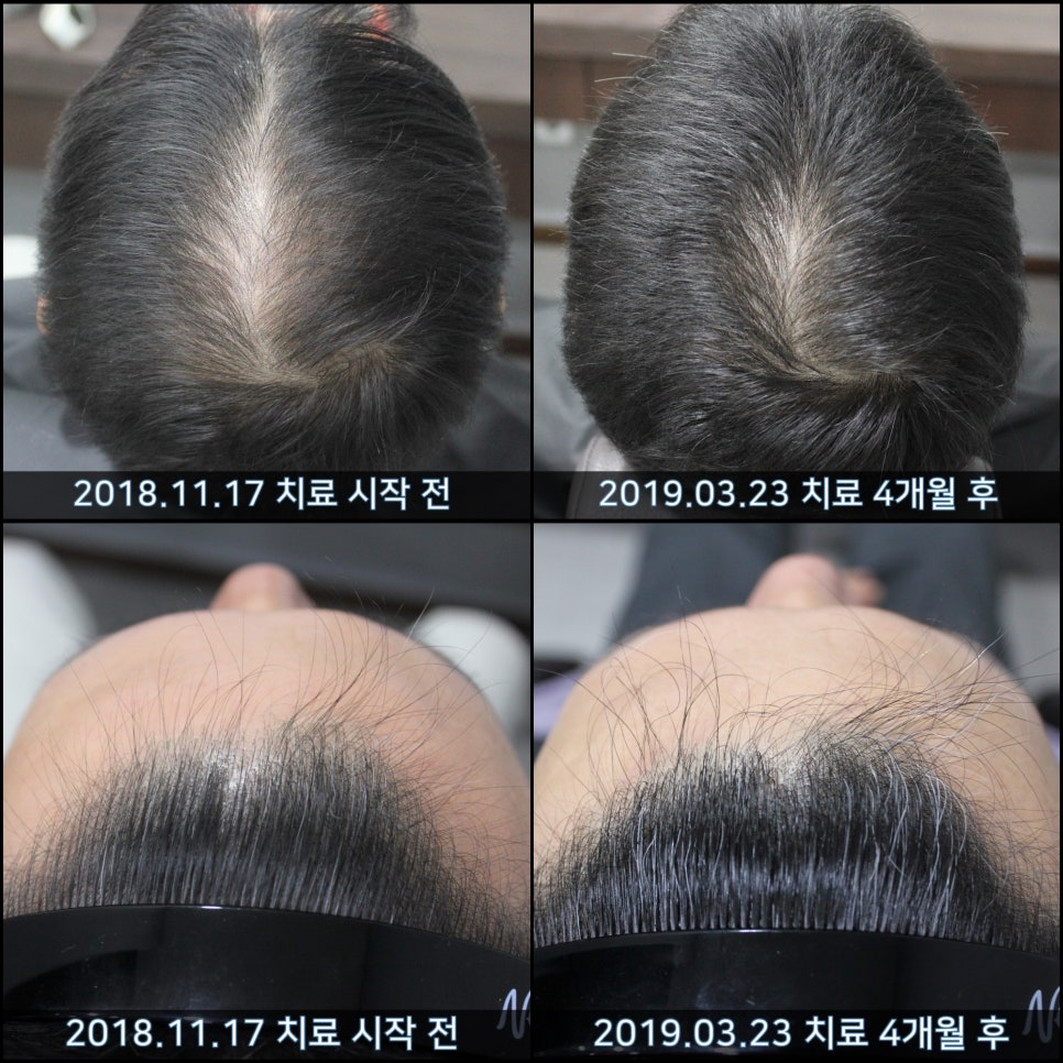 연세봄빛피부과 탈모치료 #31 (탈모와 모자 착용, 남성형탈모, 이마탈모, 정수리탈모) 관련 이미지 5