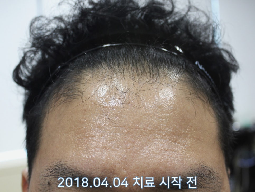 연세봄빛피부과 탈모치료 #20 (남성형탈모, 정수리탈모, 헤어스타일) 관련 이미지 3