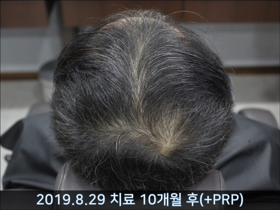 연세봄빛피부과 탈모치료 #30 (남성형탈모, 이마탈모, 정수리탈모) 관련 이미지 4