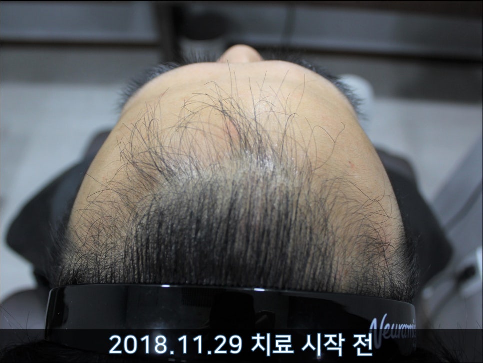 연세봄빛피부과 탈모치료 #35 (남성형탈모, 이마탈모, 가족력없음) 관련 이미지 1