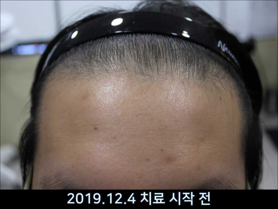 연세봄빛피부과 탈모치료 #43 (정수리탈모, F형 탈모) 관련 이미지 7