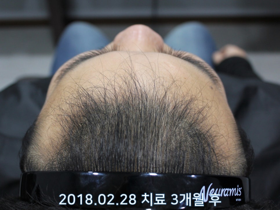 연세봄빛피부과 탈모치료 #11 (남성형탈모, 이마탈모, 정수리탈모) 관련 이미지 2