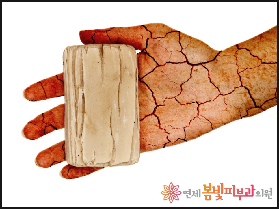 손의 습진 관리하기 관련 이미지 1