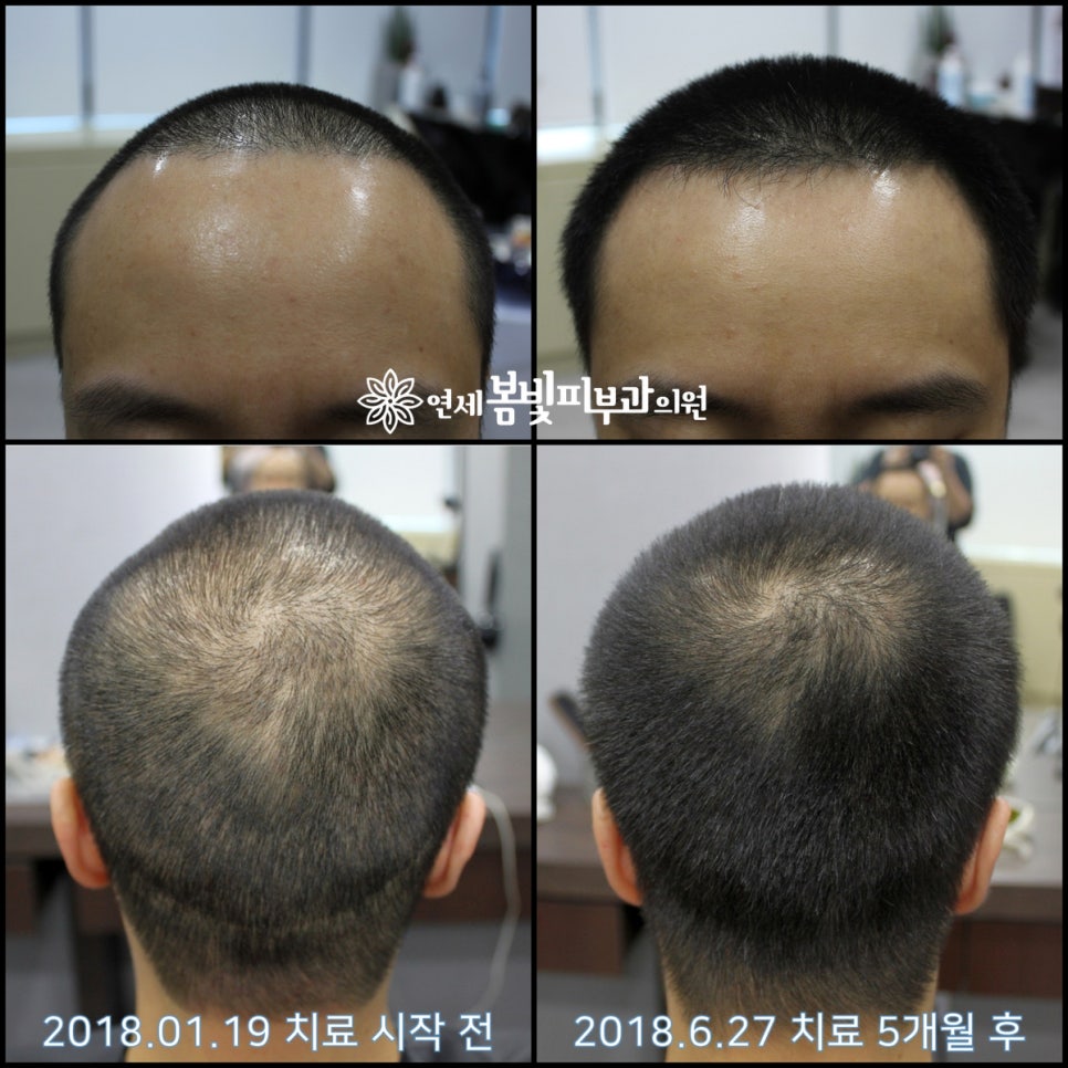 연세봄빛피부과 탈모치료 #17 (남성형탈모, 정수리탈모, F유형) 관련 이미지 8