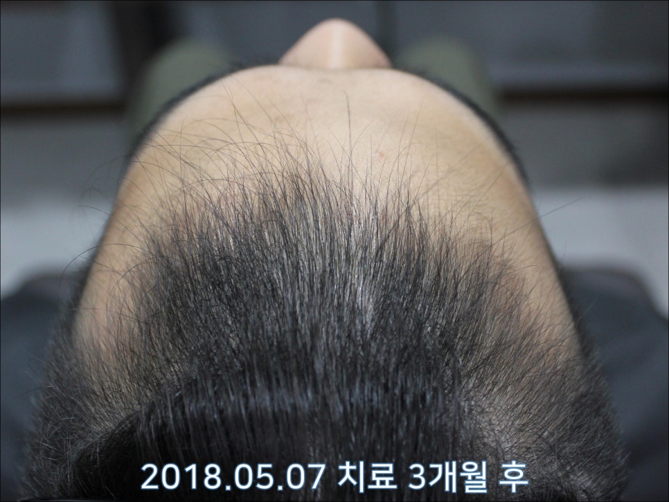 연세봄빛피부과 탈모치료 #25 (남성형탈모, 재치료, 이마탈모, 정수리탈모) 관련 이미지 7