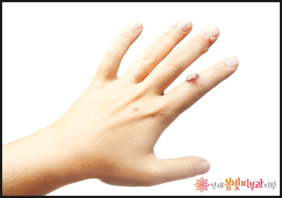 바이러스성 사마귀는 왜 자꾸 생길까요? (보통 사마귀, 편평 사마귀, 손발바닥 사마귀, 냉동치료,  블레오마이신 주사 치료, 레이저 치료) 관련 이미지 5