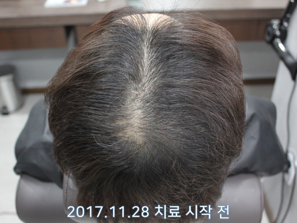 연세봄빛피부과 탈모치료 #7 (남성형탈모, 이마탈모, 정수리탈모) 관련 이미지 3