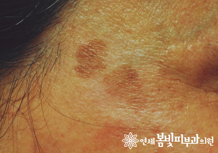 다양한 얼굴 색소 치료 #2 (흑자 없애는법, 검버섯 없애는법) 관련 이미지 1