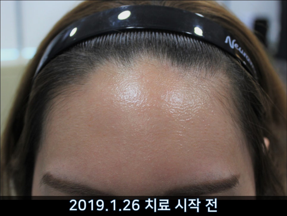 연세봄빛피부과 탈모치료 #37 (여성형탈모, 정수리탈모) 관련 이미지 7
