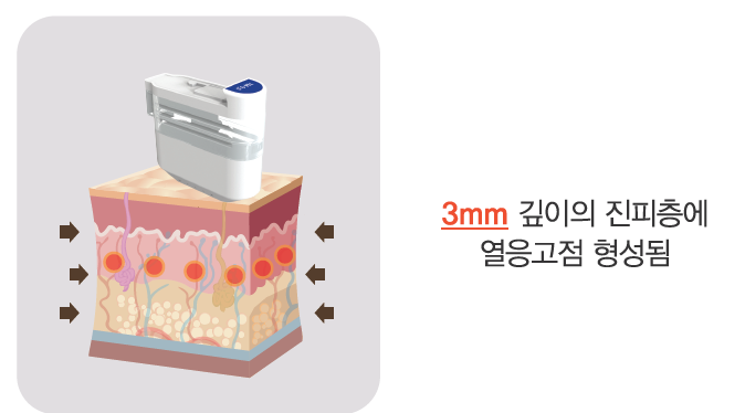 리프팅 레이저의 새로운 강자, 울트라스킨 플러스 도입 관련 이미지 5