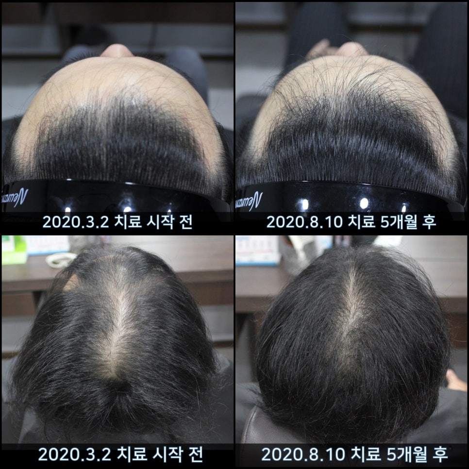 연세봄빛피부과 탈모치료 #44 (남성형탈모,M형+C형탈모) 관련 이미지 8