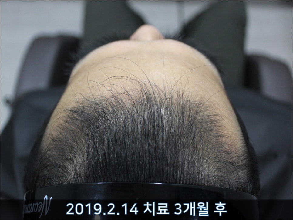 연세봄빛피부과 탈모치료 #35 (남성형탈모, 이마탈모, 가족력없음) 관련 이미지 2