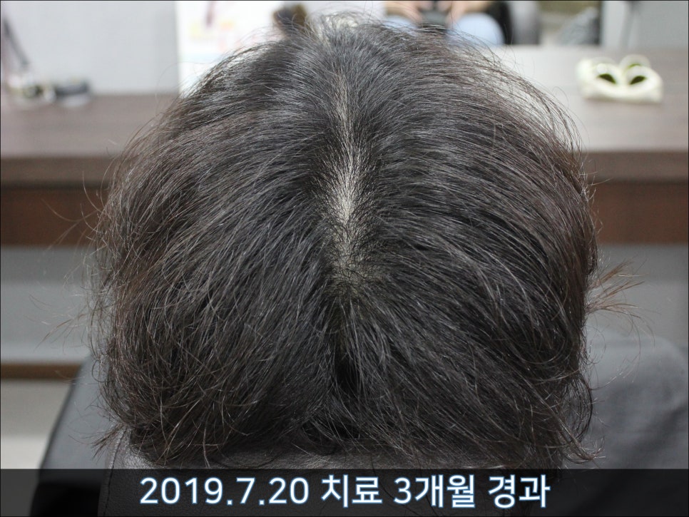 연세봄빛피부과 탈모치료 #42 (남성형탈모,M자탈모) 관련 이미지 11