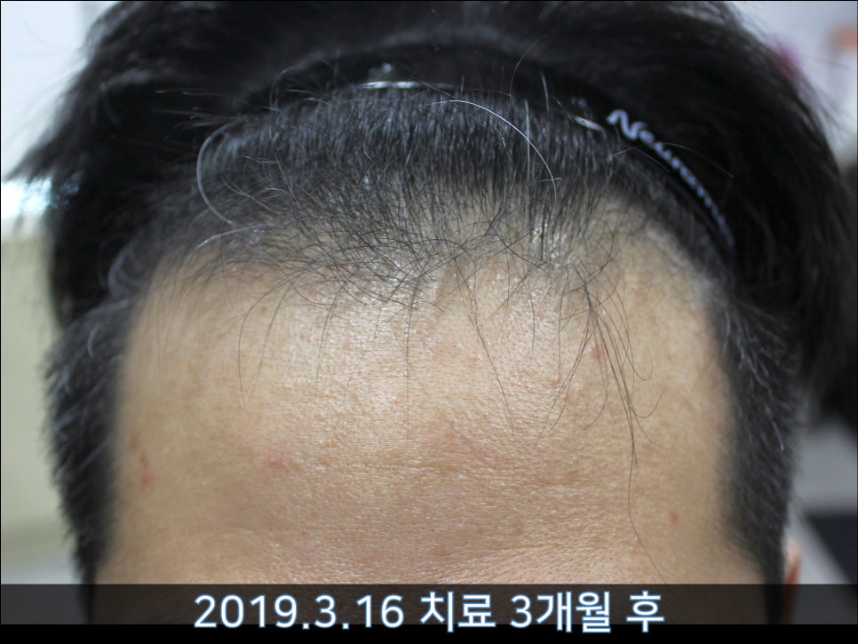 연세봄빛피부과 탈모치료 #36 (남성형탈모, 이마탈모, 3개월) 관련 이미지 4