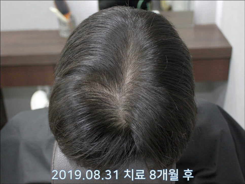 연세봄빛피부과 탈모치료 #28 (남성형탈모, 정수리탈모) 관련 이미지 3