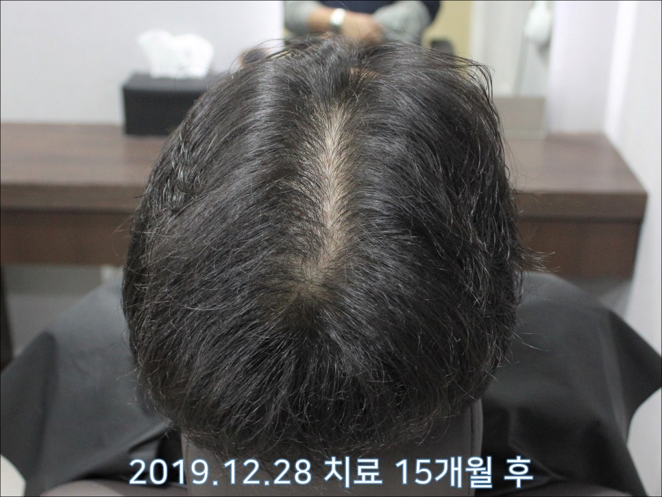 연세봄빛피부과 탈모치료 #29 (남성형탈모, 정수리탈모, 15개월간 장기 치료) 관련 이미지 4