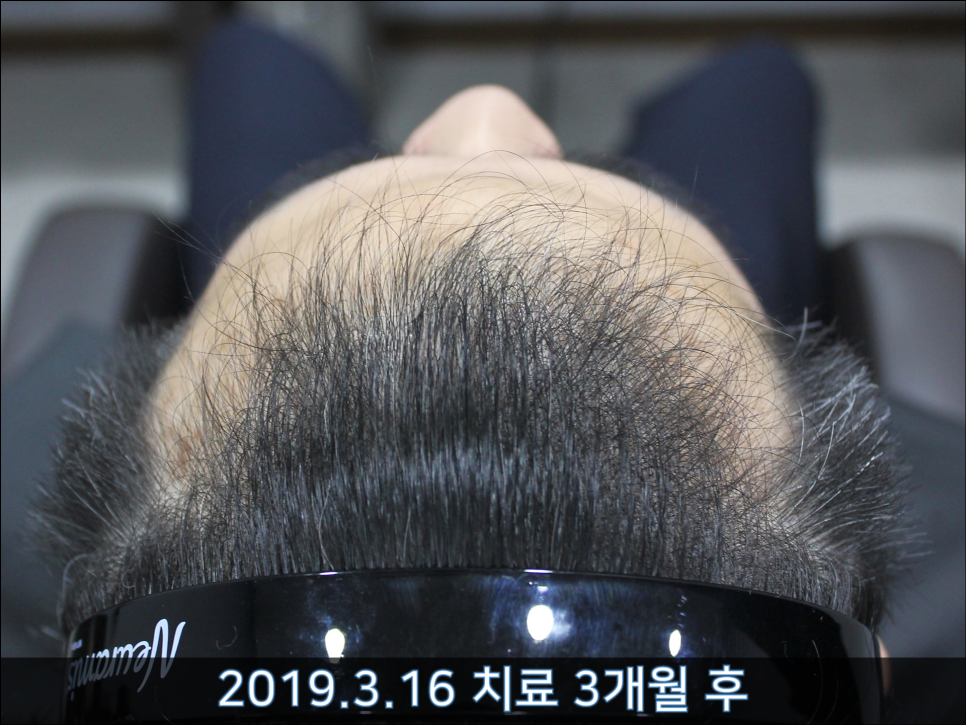 연세봄빛피부과 탈모치료 #36 (남성형탈모, 이마탈모, 3개월) 관련 이미지 2