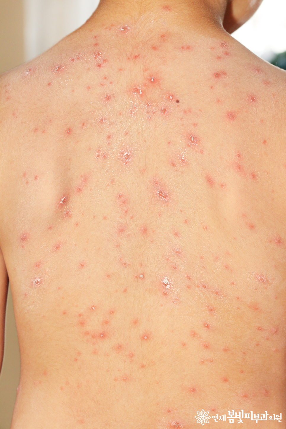 수두 예방접종을 했는데도 수두에 걸릴 수 있나요? (수두, chickenpox, 바이러스성 피부질환, 피부질환 잘 보는 피부과) 관련 이미지 1