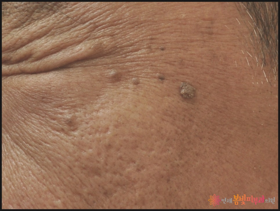 바이러스성 사마귀는 왜 자꾸 생길까요? (보통 사마귀, 편평 사마귀, 손발바닥 사마귀, 냉동치료,  블레오마이신 주사 치료, 레이저 치료) 관련 이미지 6