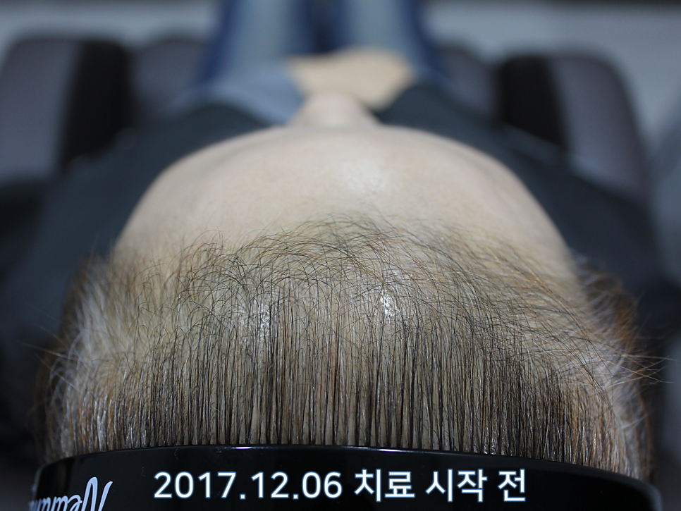 연세봄빛피부과 탈모치료 #6 (여성형탈모, 정수리탈모) 관련 이미지 4