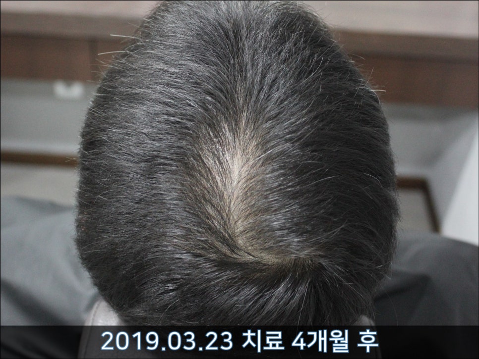연세봄빛피부과 탈모치료 #31 (탈모와 모자 착용, 남성형탈모, 이마탈모, 정수리탈모) 관련 이미지 2