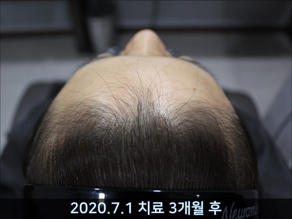 연세봄빛피부과 탈모치료 #45 (AI를 이용한 탈모 치료 성과 분석) 관련 이미지 5