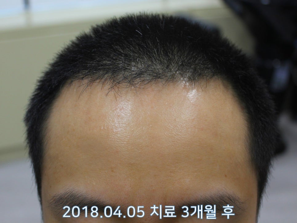 연세봄빛피부과 탈모치료 #17 (남성형탈모, 정수리탈모, F유형) 관련 이미지 3